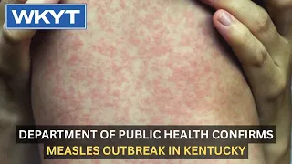 Department of Public Health confirms measles outbreak in Kentucky