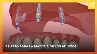 Do you need a dental prosthesis? Learn about the All-on-4 treatment
