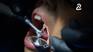 Do you have cavities? Learn about the different types and their risks