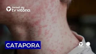 Chickenpox cases on the rise in the South