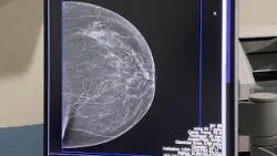 Early Breast Cancer Diagnosis
