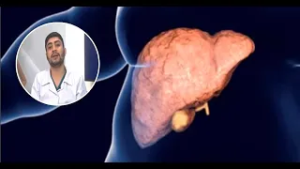 Hígado graso: especialista advierte que no es "normal" tener exceso de grasa en el órgano