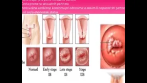 Maligne bolesti sve više pogadjaju mlade