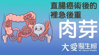 【大愛醫生館】 直腸癌術後的裡急後重 20260730