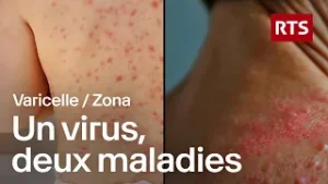 Zona : quand le virus de la varicelle se réveille | RTS