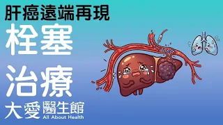 【大愛醫生館】 肝癌遠端再現 20260817