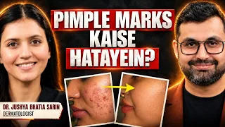 Clear Skin Kaise Milegi? Pimple Kaise Hatayein? | Dr. Jushya Bhatia Sarin