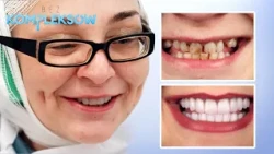 Usunęli jej 8 zębów i wstawili 6 implantów! 😱 Zobacz nowy uśmiech Ani | Bez kompleksów