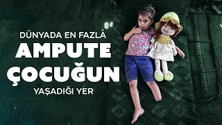 The scars of genocide in Gaza on children's bodies