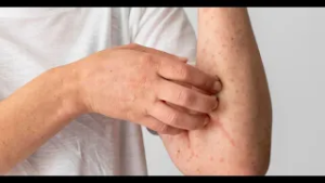 Fuertes vientos y polvo disparan alergias en la temporada