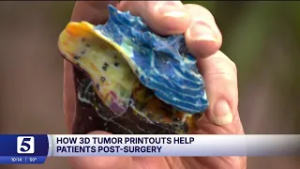 How are 3D printed tumors helping cancer patients after surgery?