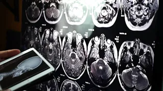 Arkansas Alzheimer's Association pushes to improve brain health