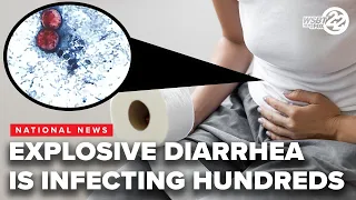 Explosive diarrhea is one symptom of a parasite outbreak in the U S
