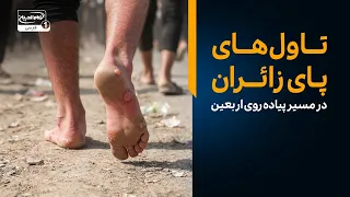 معجزه تاول‌های پای زائران در مسیر مشایه | گزارش زنده پیاده روی اربعین 1405