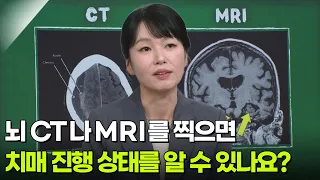 뇌 CT나 MRI를 찍으면 치매 진행 상태를 알 수 있나요? [아침마당] | KBS 260903 방송