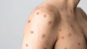 Mpox: saiba como a doença é transmitida e como se proteger