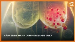 Breast Cancer and Bone Metastasis: Understanding the Real Diagnosis