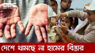 থামছে না হামের বিস্তার, শিশুর পুষ্টি নিশ্চিতসহ স্বাস্থ্যবিধি মানায় জোর | DBC NEWS