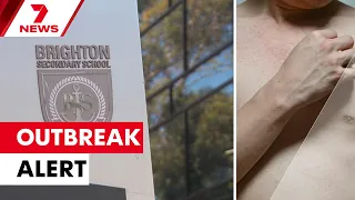 Health officials on alert after measles outbreak in South Australia | 7NEWS