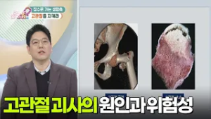 장수로 가는 생명축! 고관절을 지켜라! [무엇이든 물어보세요] | KBS 260219 방송