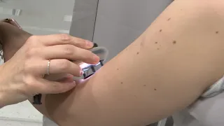 Zaštita kože od sunca - stručnjaci već godinama upozoravaju da broj oboljelih od melanoma raste