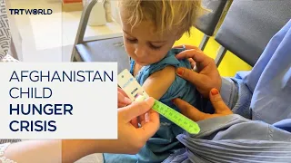 UN says nearly 4M Afghan children acutely malnourished