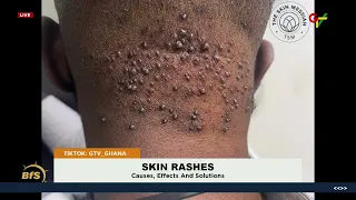 Skin Rashes, Causes, Effects and Solutions