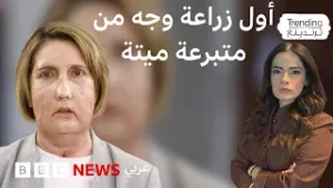 "أصبحت أشبه نفسي" ما قصة أول زراعة وجه من متبرعة ميتة؟