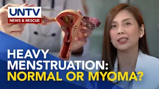 Kailan nagiging delikado ang Heavy Menstruation at paano ito nagiging sintomas ng Myoma?