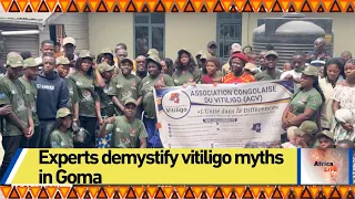 Experts demystify vitiligo myths in Goma
