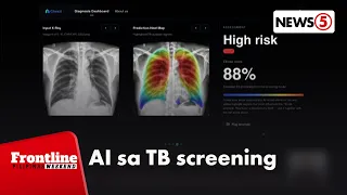 TB screening, pinadali gamit ang artificial intelligence | Frontline Weekend