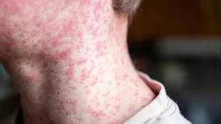 Ministry of Health reports 50 measles cases in the country