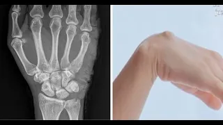 Orthopedist explains ganglions: "they are little balloons of synovial fluid"