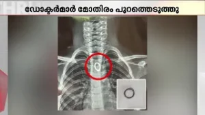 കളിക്കുന്നതിനിടെ മോതിരം വിഴുങ്ങി ഏഴുവയസുകാരൻ! എൻഡോസ്കോപ്പി വഴി പുറത്തെടുത്ത് ഡോക്ടർമാർ