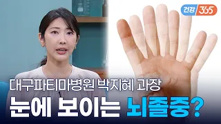 사물이 둘로 겹쳐 보인다면?😵‍💫｜단순 눈 피로가 아닌 뇌졸중 전조증상일 수도! [TBC클리닉건강365]