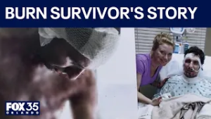 Burn survivor 'Miracle' Matt Manzari survives electrocution, sharing near-death experience