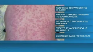 What to know about the measles cases reported in Sacramento County