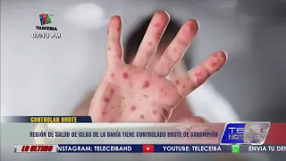Bay Islands Health Region has measles outbreak under control