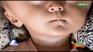 Hydrocephalus: an anomaly that increases the size of a child's head.