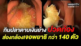 A Cautionary Tale: Severe Stomach Pain After Eating Grilled Hairtail Fish Reveals Over 140 Parasi...