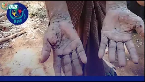 ပွင့်ဖြူမြို့နယ်က စစ်ဘေးရှောင်ပြည်သူတွေ အရေပြားယားနာ ရောဂါ ဖြစ်ပွား - DVB News