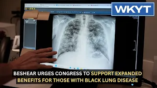 Beshear urges Congress to support expanded benefits for those with black lung disease