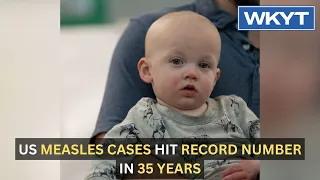 US measles cases hit record number in 35 years