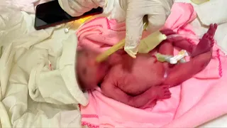 Baby born in Quimilí at 24 weeks gestation weighing only 500 grams