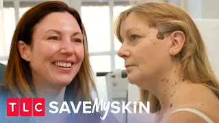 Holy Mole-y! Moles & Tags | Save My Skin | TLC