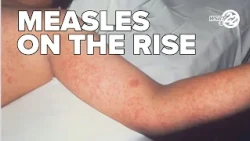 Measles on the rise, officials urge MMR vaccine to prevent infection