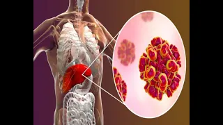 Zašto hepatitis nazivaju "tihom bolešću"