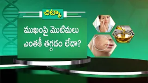 ముఖంపై మొటిమలు ఎంతకీ తగ్గడం లేదా ? | Health Tip | Sukhibhava | ETV Life