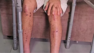 Dois acidentes em dois meses deixam motoboy sem renda e necessitando de ajuda