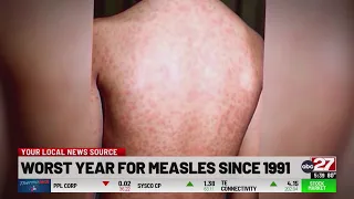 Officials: 2026 is worst year for measles in U.S. since 1991